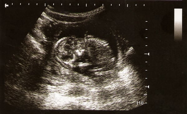 Ultrasound-image